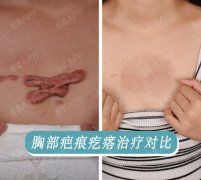 疤痕增生是什么意思
